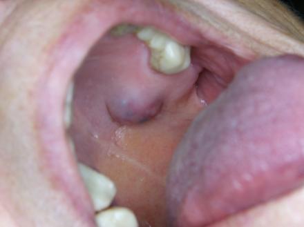 Tumor de glândula salivar menor (adenoma pleomórfico)